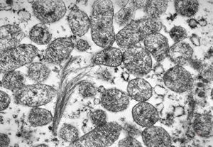 F,27y. | oncocytoma - kidney F,27y. | oncocytoma - kidney